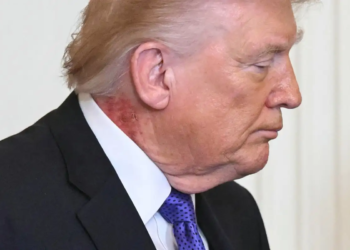 Trump genera alerta por salpullido rojo en el cuello durante acto en la Casa Blanca