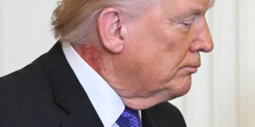 Trump genera alerta por salpullido rojo en el cuello durante acto en la Casa Blanca