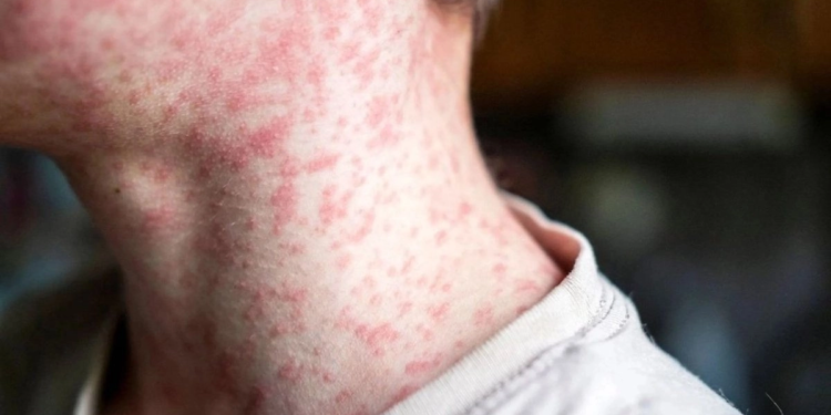 Suspenden acceso a centro penitenciario en cárcel de Texas por brote de sarampión