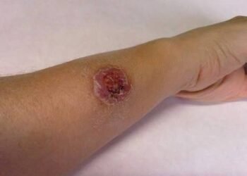 Quintana Roo encabeza casos de leishmaniasis