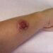 Quintana Roo encabeza casos de leishmaniasis