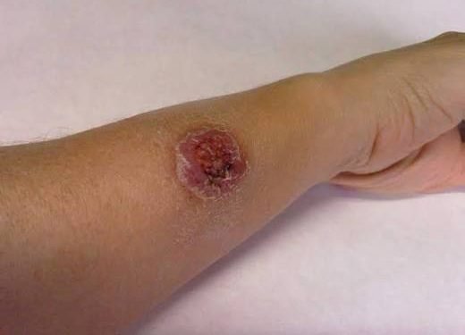 Quintana Roo encabeza casos de leishmaniasis